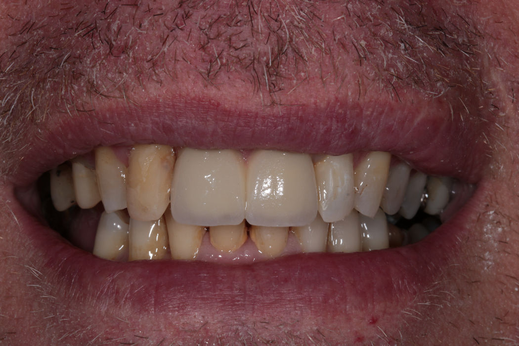 Εμφυτεύματα στην αισθητική ζώνη